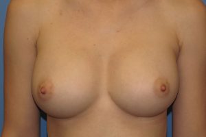 after breast augmentation front view female patient case 6499