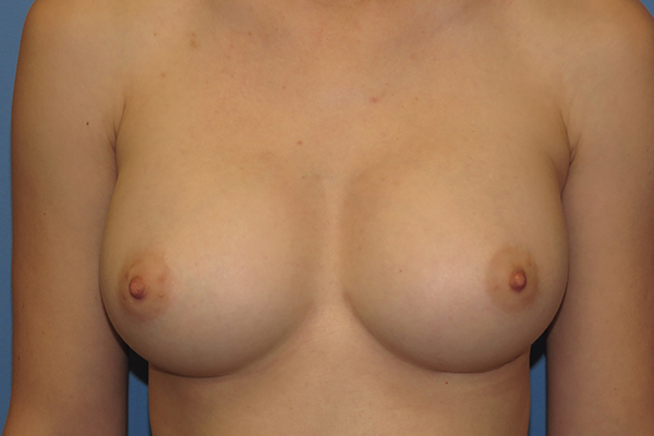 after breast augmentation front view female patient case 6499