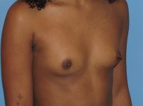 before breast augmentation right angle view female patient case 6667