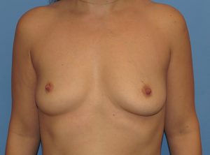 before breast augmentation front view female patient case 6693