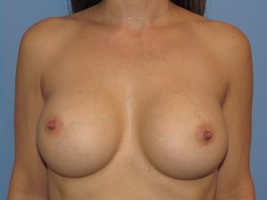 after breast augmentation front view female patient case 6693