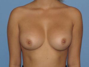 after breast augmentation front side view female patient case 6789