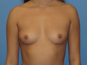 before breast augmentation front view female patient case 6789