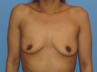 before breast augmentation front view female patient case 6838