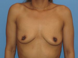 before breast augmentation front view female patient case 6838